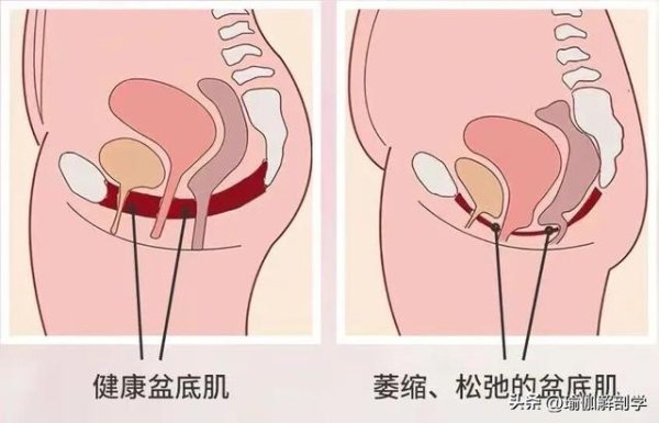日天金策略 每天躺着抬腿100次，盆底肌紧了，腰背也不痛了